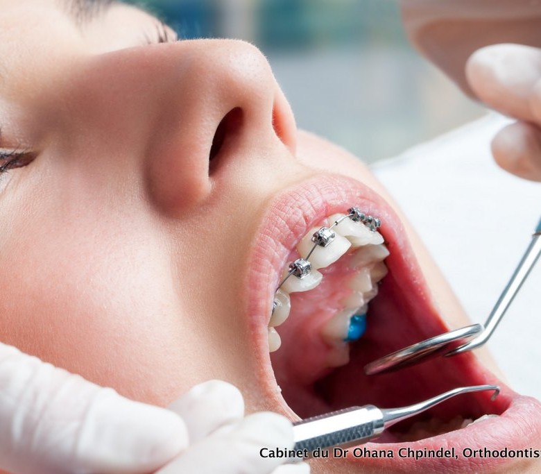 Traitement orthodontique, orthodontie paris, pose appareil dentaire metallique