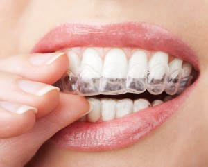 Invisalign Paris - gouttières transparentes