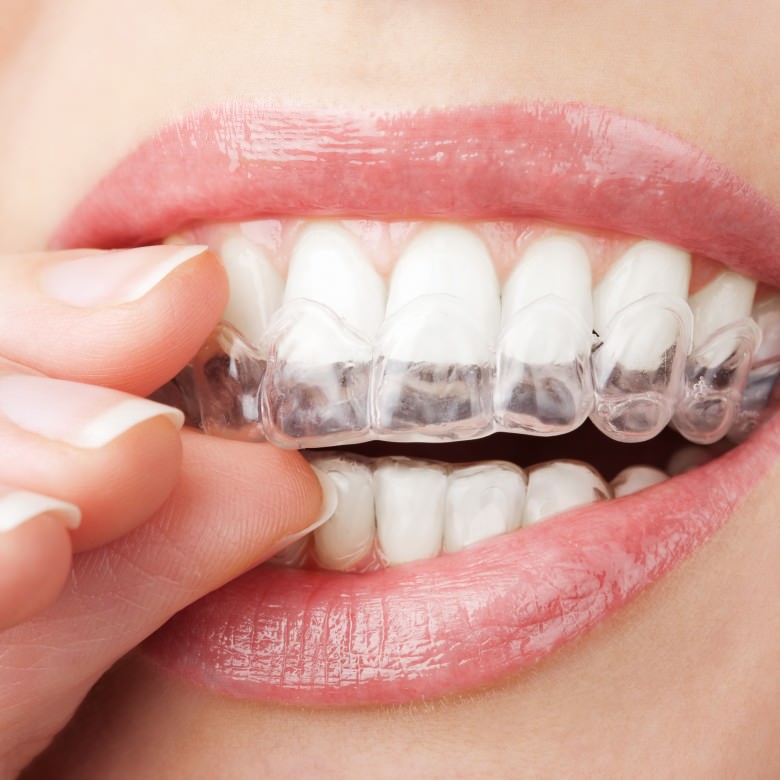 Invisalign Paris - gouttières transparentes