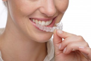 Invisalign Paris - orthodontie invisible