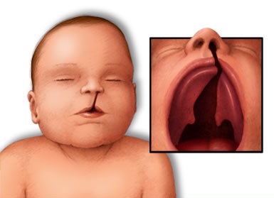 Fente labio-Palatine e traitement orthodontique