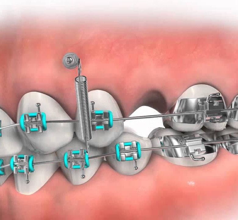 vis ancrage machoire schema