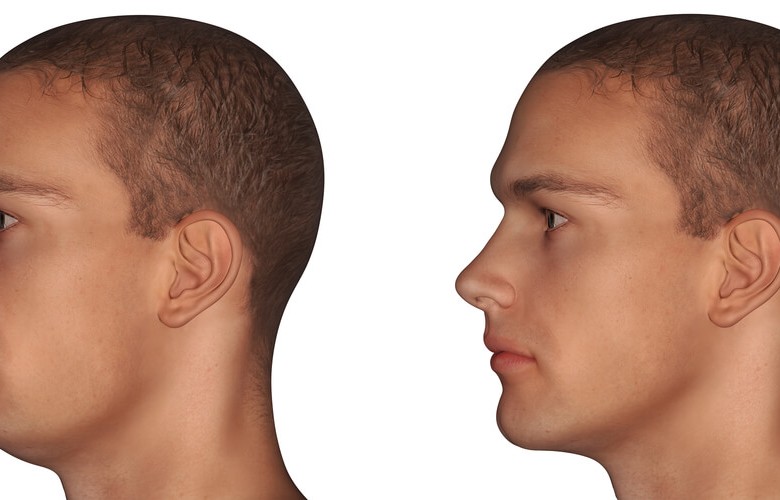 Chirurgie maxillo-faciale et Orthodontie