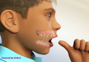 Orthodontie et succion du pouce