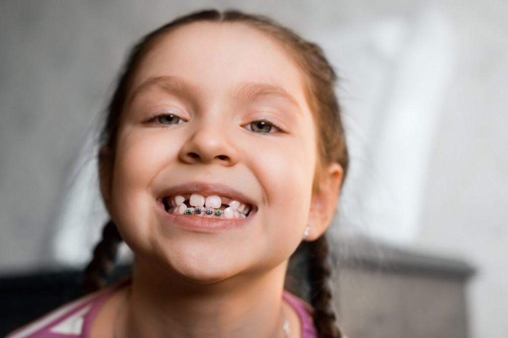 Traitement interception en orthodontie enfant