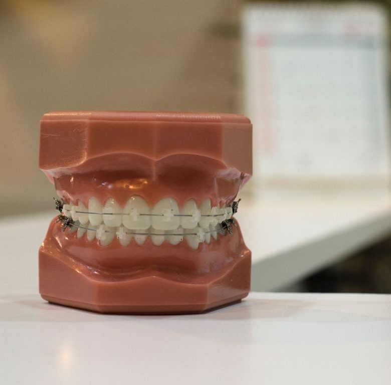 Appareil dentaire céramique comme traitement pour vos dents