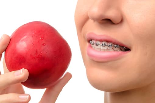 Alimentation à adopter lors d'un traitement orthodontique Paris