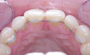 Dr Ohana Chpindel propose contention dentaire Paris