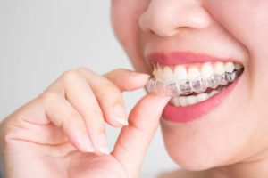 Le Dr Ohana Chpindel propose gouttière orthodontie Paris