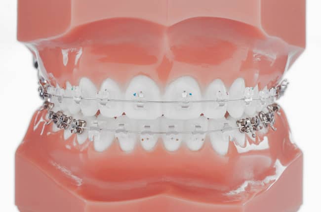 Malpositions et Malocclusions à Paris