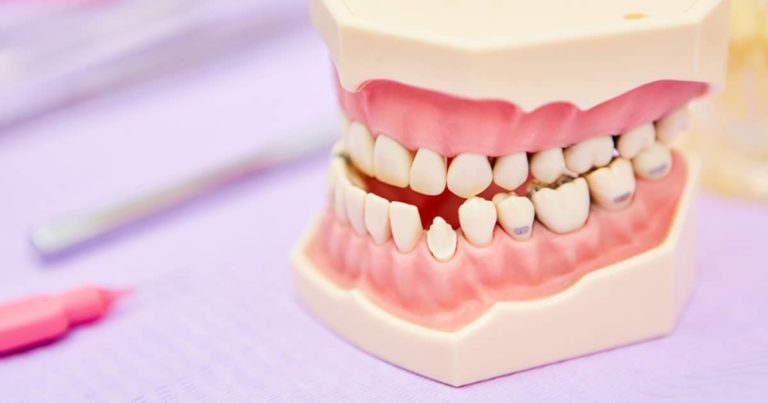 Le Dr Ohana chpindel propose l'encombrement dentaire Paris