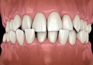 Votre orthodontiste Paris corrige vos anomalies dentaires