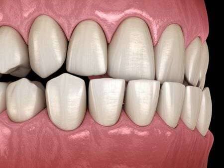 Le Dr Ohana Chpindel corrige votre prognathie