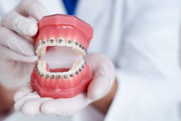 Votre orthodontiste paris propose des solutions pour les supraclusion