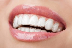 Contres indications traitement invisalign Paris