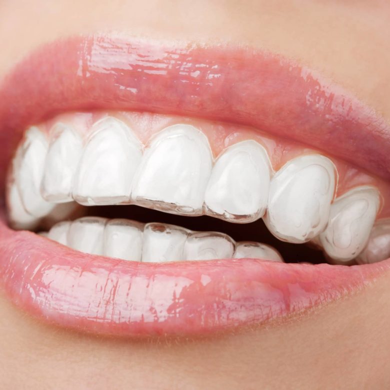 Contres indications traitement invisalign Paris