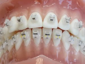 Traitement orthodontique déplacement des dents Paris