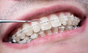 Pourquoi se lancer dans un Traitement orthodontique Paris 