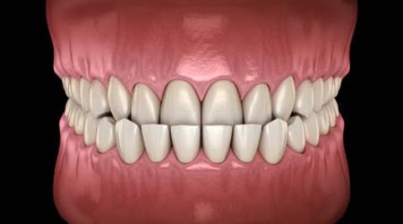 Le Dr Ohana Chpindel corrige vos anomalies Classe 3 orthodontiste paris