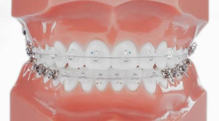 Malpositions et Malocclusions à Paris