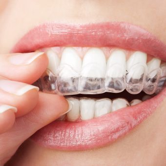 Invisalign Paris - gouttières transparentes