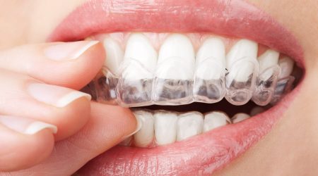 Invisalign Paris - gouttières transparentes