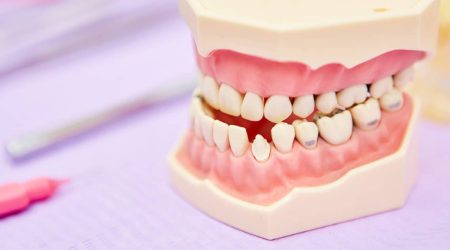 Le Dr Ohana chpindel propose l'encombrement dentaire Paris