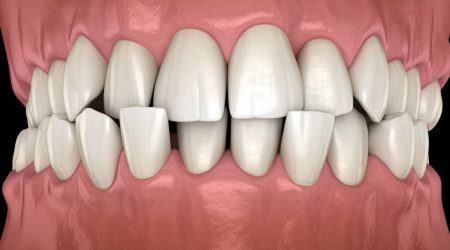 Votre orthodontiste Paris corrige vos anomalies dentaires