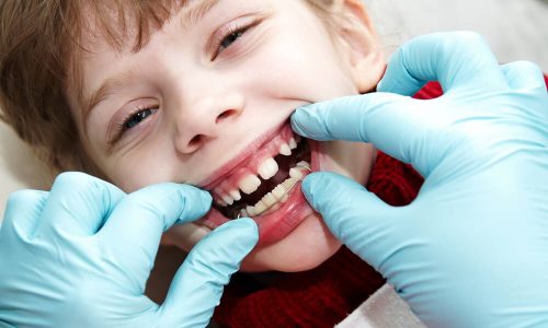 Traitement en orthodontie fonctionnelle a Paris