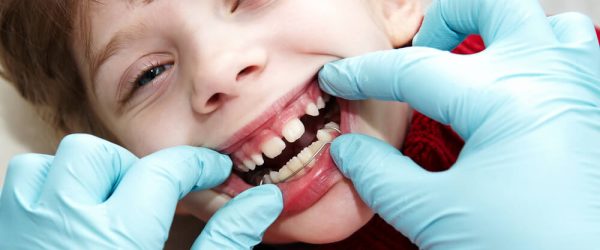 Traitement en orthodontie fonctionnelle a Paris