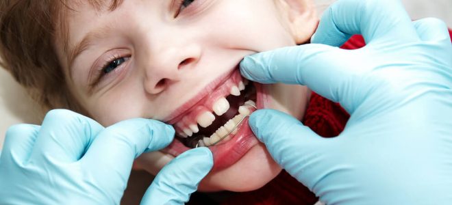 Traitement en orthodontie fonctionnelle a Paris