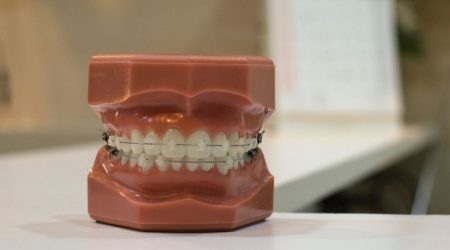 Appareil dentaire céramique comme traitement pour vos dents