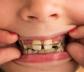 interception en orthodontie enfant