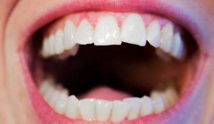 Traitement d'orthodontie invisible efficace et de qualité