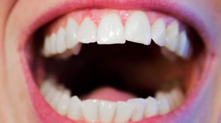 Traitement d'orthodontie invisible efficace et de qualité