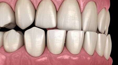 Le Dr Ohana Chpindel corrige votre prognathie