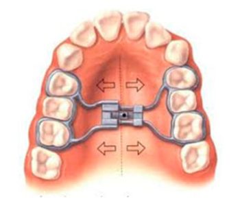 hyrax : appareil d'expansion de la machoire orthodontiste paris 17
