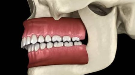 Dr Ohana Chpindel corrige votre retrognathie