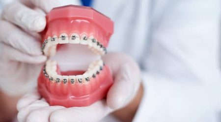 Votre orthodontiste paris propose des solutions pour les supraclusion