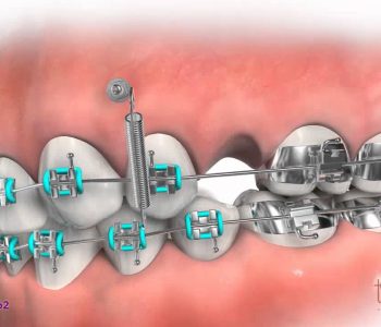 vis ancrage machoire schema